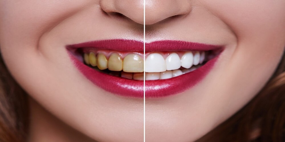 Oral Care - FAQs about Whitening Strips